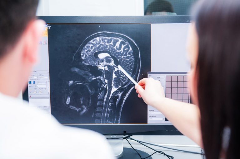 Doctors magnetic resonance image (MRI) injured brain, head injury Accident Claims Brighton